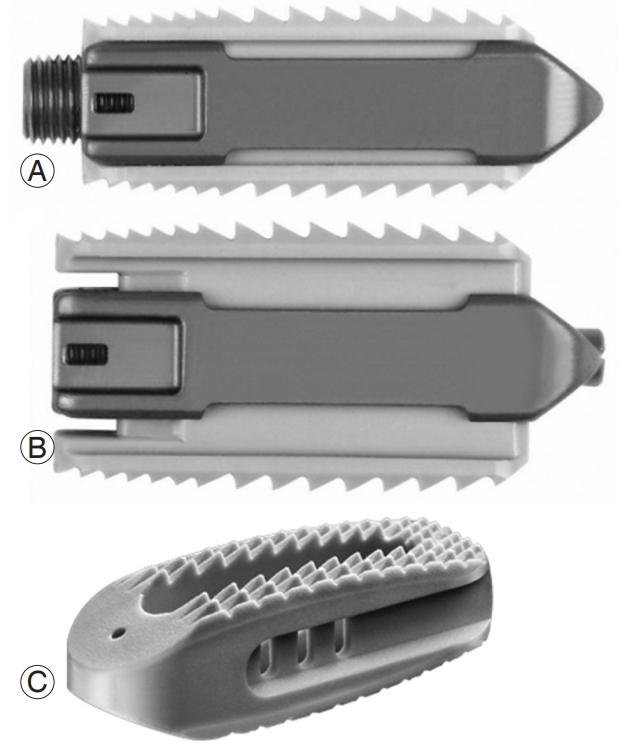 Continuously expandable interbody spacer in (A) minimized and (B)